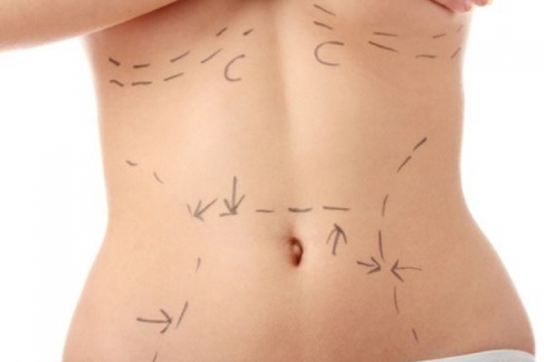 LIPOSUCTION